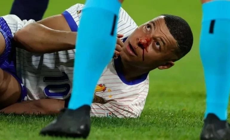 Mbappé termina ensangrentado