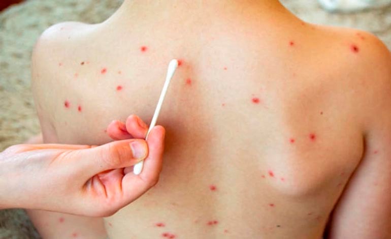 El brote de sarampión en EE. UU. supera los 1.000&nbsp;casos